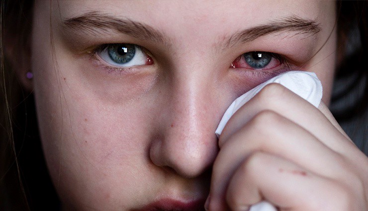 7 Amazing Home Remedies For Inflamed Eyes ..!