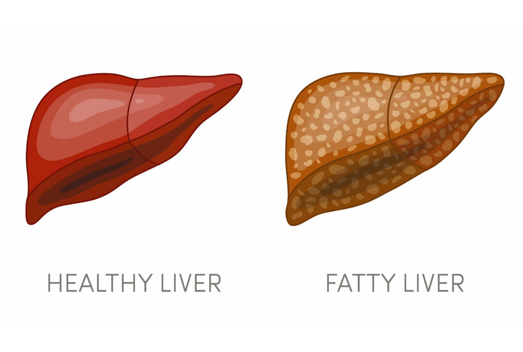 reduce fatty liver problem in these ways