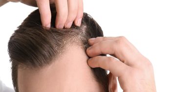 Dandruff : చుండ్రుని శాశ్వతంగా తొలగించే చిట్కాలు..!