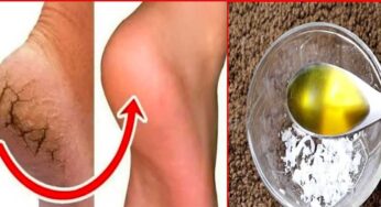 Cracked Heels : ఈ చిట్కాలను పాటిస్తే.. మీ పాదాల పగుళ్లు మాయమైపోతాయి..!