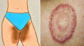 Ringworm : తొడలు, గ‌జ్జ‌ల్లో గజ్జి, తామ‌ర‌, దుర‌ద ఉన్నాయా ? ఈ చిట్కాల‌ను పాటిస్తే.. 100 శాతం స‌మ‌స్య‌ల‌ను త‌గ్గించుకోవ‌చ్చు..!