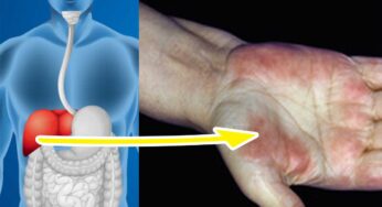 Fatty Liver : లివ‌ర్‌లో కొవ్వు ఎక్కువ‌గా పేరుకుపోతే క‌నిపించే ల‌క్ష‌ణాలు ఇవే.. జాగ్ర‌త్త ప‌డ‌క‌పోతే ప్ర‌మాదం..
