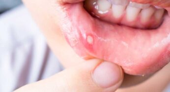 Mouth Ulcer : నోట్లో పుండ్లు ఉన్నాయా ? ఇలా చేస్తే ఒక్క రోజులోనే త‌గ్గిపోతాయి..!