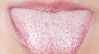 White Tongue : నాలుక ఎల్ల‌ప్పుడూ తెల్ల‌గా క‌నిపిస్తుందా ? అయితే మీకు ఈ అనారోగ్య స‌మ‌స్య‌లు ఉన్న‌ట్లే లెక్క‌..!