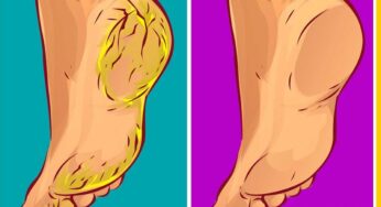 Cracked Heels : ఇలా చేస్తే పాదాల ప‌గుళ్లు తగ్గిపోతాయి.. ఇక జ‌న్మ‌లో రావు..!