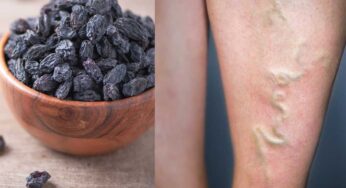 Varicose Veins : వెరికోస్ వీన్స్ (రక్త‌నాళాలు ఉబ్బిపోవ‌డం) ఉన్న‌వారు.. ఈ చిట్కాల‌ను పాటించి చూడండి..!