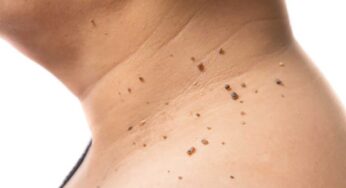 Warts : ఈ చిట్కాను పాటిస్తే పులిపిర్లు శాశ్వ‌తంగా రాలిపోతాయి..!