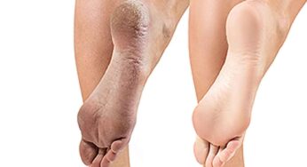 Cracked Heels : పాదాల ప‌గుళ్ల‌ను త‌గ్గించే అద్భుత‌మైన చిట్కా.. వారం రోజుల్లో మార్పు వ‌స్తుంది..!