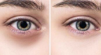Dark Circles : క‌ళ్ల కింద న‌ల్ల‌ని వ‌ల‌యాల‌ను తగ్గించే అద్భుత‌మైన చిట్కా..!
