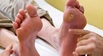 Diabetic Foot : షుగ‌ర్ అధికంగా ఉంటే పాదాల్లో క‌నిపించే ల‌క్షణాలు ఇవే..!