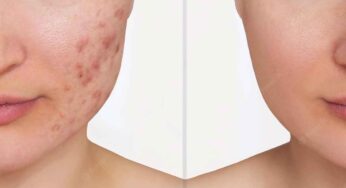 Beauty Tips : దీన్ని ముఖానికి రాస్తే.. మొటిమ‌లు, మ‌చ్చ‌లు దెబ్బ‌కు మాయం అవుతాయి..