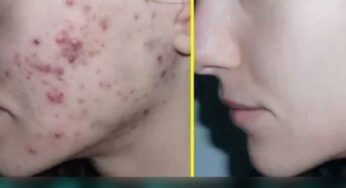 Pimples : ఈ పేస్ట్‌ను రాస్తే.. ఎలాంటి మొటిమ‌లు అయినా స‌రే వెంట‌నే త‌గ్గుతాయి..!