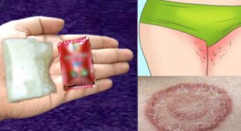 Ringworm : తొడలు, గజ్జల్లో వచ్చే గజ్జి, తామర, దురదలను 3 రోజుల్లోనే ఇలా త‌గ్గించుకోవ‌చ్చు..!