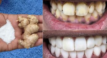 Teeth : ఎంతటి గార పట్టిన, పసుపు దంతాలు అయినా స‌రే.. ఇలా చేస్తే.. ముత్యాల్లా మెరిసిపోతాయి..
