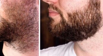 Beard Growth : ఈ చిట్కాల‌ను పాటిస్తే.. గ‌డ్డం బాగా పెరుగుతుంది..!