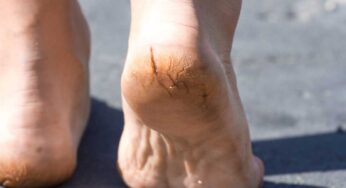 Cracked Heels : పాదాల ప‌గుళ్లు త‌గ్గి మృదువుగా మారాలంటే.. ఈ చిట్కాల‌ను పాటించాలి..!
