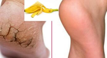 Banana Peel For Cracked Heels : పాదాల ప‌గుళ్ల‌ను త‌గ్గించేందుకు అర‌టి తొక్క ఎంతో ఉప‌యోగ‌ప‌డుతుంది.. ఎలా వాడాలంటే..?