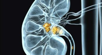 Kidney Stones : వీటిని తీసుకున్నారంటే.. ఎంత‌టి కిడ్నీ స్టోన్లు అయినా స‌రే క‌రిగిపోవాల్సిందే..!