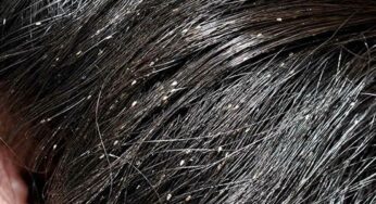 Lice Remedy : త‌ల‌లో పేల స‌మ‌స్య‌కు అద్భుత‌మైన చిట్కా.. ఇలా చేయాలి..!