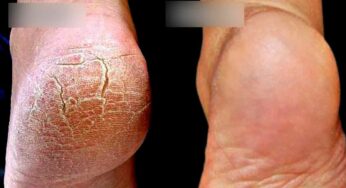 Padala Pagullu : పాదాల ప‌గుళ్ల‌ను త‌గ్గించే అద్భుత‌మైన చిట్కా.. ఇలా చేస్తే చాలు.. వేగంగా ఫ‌లితం..