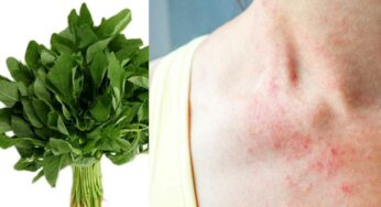 Thotakura For Skin Problems : ఎలాంటి చ‌ర్మ స‌మ‌స్య‌లు ఉన్నా స‌రే.. ఈ ఆకుకూర‌తో మ‌టుమాయం అవుతాయి..