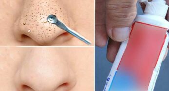 Blackheads : కేవ‌లం 5 నిమిషాల్లోనే బ్లాక్ హెడ్స్‌ను నిర్మూలించే అద్భుత‌మైన చిట్కా.. ఇలా చేయాలి..!