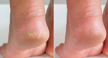 Cracked Skin Foot : మీ పాదాల ప‌గుళ్ల‌ను పోగొట్టి అందంగా మార్చే చిట్కాలు.. ఏం చేయాలంటే..?