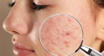 Pimples : మీ ముఖంపై ఏర్ప‌డే మొటిమ‌లే.. మీరు ఆరోగ్యంగా ఉన్నారో లేదో చెప్పేస్తాయి..!