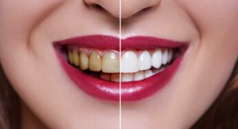 Whiten Teeth : దంతాల‌పై ఉండే గార పోయి తెల్ల‌గా మారుతాయి.. ఇలా చేస్తే చాలు..!