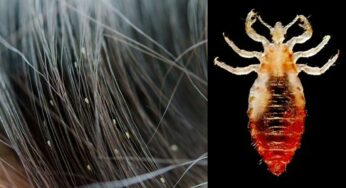 Lice : ఇలా చేశారంటే చాలు.. నిమిషాల్లో పేలు మాయం.. జ‌న్మ‌లో మ‌ళ్లీ రావు..!