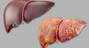 Liver Failure Symptoms : ఈ ల‌క్ష‌ణాలు మీలో క‌నిపిస్తే.. 70 శాతం వ‌ర‌కు లివ‌ర్ పాడైపోయిన‌ట్లే..!