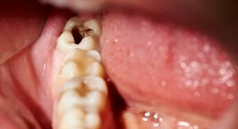 Teeth Cavity : పిప్పి ప‌న్ను స‌మ‌స్య‌కు చ‌క్క‌ని ప‌రిష్కారం.. ఇలా చేయాలి..
