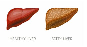 Fatty Liver Home Remedy : దీన్ని తీసుకుంటే చాలు.. లివ‌ర్‌లో ఉండే కొవ్వు మొత్తం క‌రిగిపోతుంది..!
