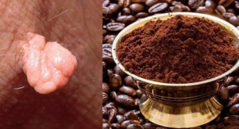 Skin Tags : కాఫీ పొడితో ఇలా చేస్తే చాలు.. పులిపిర్లు వెంట‌నే రాలిపోతాయి..!