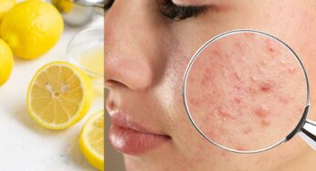 Lemon Juice For Pimples : నిమ్మ‌ర‌సంతో ఇలా చేస్తే చాలు.. మొటిమ‌లు దెబ్బ‌కు మాయ‌మ‌వుతాయి..!