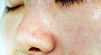 Oily Skin Home Remedies : ఈ చిట్కాల‌ను పాటిస్తే చాలు.. మీ ముఖంపై జిడ్డు అస‌లు లైఫ్‌లో రాదు..!
