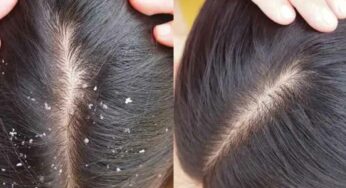 Dandruff : ఎంత పెచ్చులు క‌ట్టినా స‌రే.. 5 రోజుల్లో చుండ్రు ప‌రార్ అవుతుంది.. ఇలా చేయండి..!