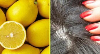 Lemon For Dandruff : చుండ్రు ఉన్న‌వారు నిమ్మ‌ర‌సం వాడితే త‌గ్గిపోతుందా..? ఇందులో నిజ‌మెంత‌..?