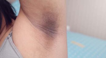 Dark Armpits : చంక‌ల్లో ఉండే న‌లుపుద‌నం తొల‌గించుకునేందుకు ఈ చిట్కాల‌ను పాటించండి..!