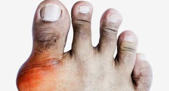 Uric Acid : యూరిక్ యాసిడ్ స‌హ‌జ‌సిద్ధంగా క‌రిగిపోవాలంటే.. ఈ చిట్కాల‌ను పాటించండి..!