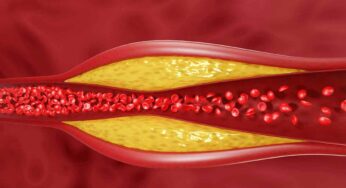 High Cholesterol Symptoms : మీ శ‌రీరంలో కొలెస్ట్రాల్ మ‌రీ ఎక్కువ‌గా ఉంద‌ని చెప్పేందుకు సంకేతాలు ఇవే.. జాగ్రత్త సుమా..!