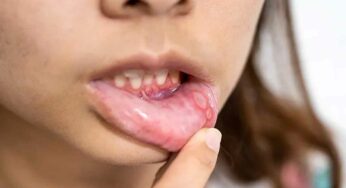 Mouth Ulcer Natural Remedies : నోట్లోని పుండ్లు త‌గ్గేందుకు మెడిసిన్ అక్క‌ర్లేదు.. ఈ ఇంటి చిట్కాలు చాలు..!