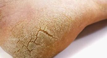 Cracked Heels : పాదాల పగుళ్ళతో బాధపడుతున్నారా..? ఇలా చేశారంటే పూర్తిగా తగ్గిపోతాయి..!