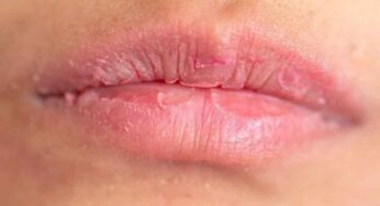Dry Lips Home Remedies : చ‌లికాలంలో మీ పెద‌వులు ప‌గ‌ల‌కుండా మృదువుగా ఉండాలంటే.. ఈ చిట్కాల‌ను పాటించండి..!