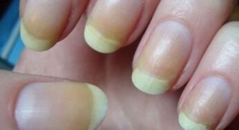Yellow Nails : మీ గోర్లు ప‌సుపు రంగులోకి మారాయా..? అయితే ఈ టిప్స్‌ను పాటించండి..!