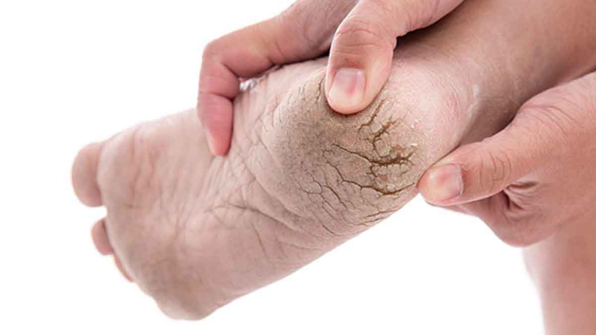 wonderful home remedy for cracked heels 