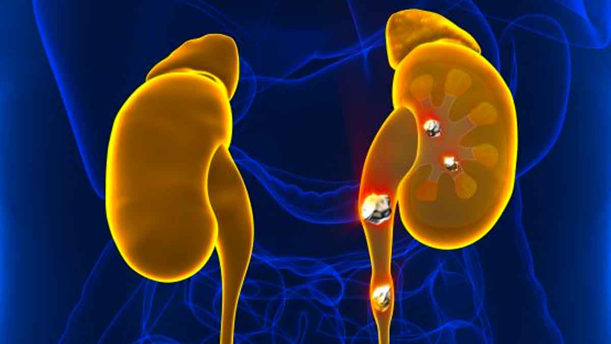 follow this diet if you have kidney stones 