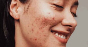 Pimples Home Remedies : మొటిమ‌ల‌ను వ‌దిలించుకోవ‌డానికి బ్ర‌హ్మాండంగా ప‌నిచేసే చిట్కాలు.. ఇవి ఫాలో అయిపొండి..!