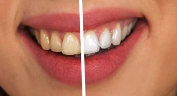 Whiten Teeth : ఈ నాచుర‌ల్ చిట్కాల‌ను పాటిస్తే చాలు.. మీ దంతాలు తెల్ల‌గా మెరిసిపోతాయి..!
