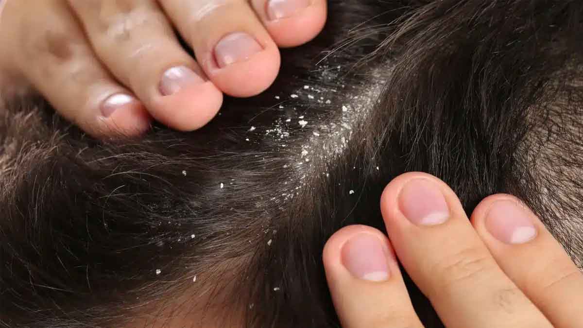 if you have dandruff sour curd is the solution 